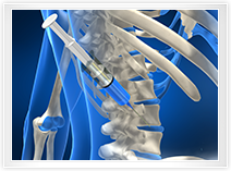 척추 약물주사요법 사진