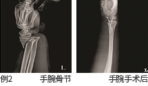 예2 팔목 골절과 팔목 수술 후 사진