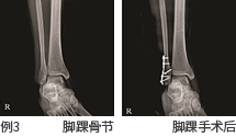 예3 발목 골절과 발목 수술 후 사진