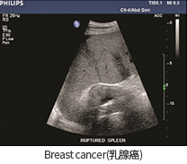 Breast cancer(유방암)