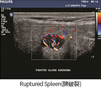 Ruptured Spleen(비장파열)