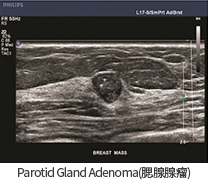 Parotid Gland Adenoma(이하선종)