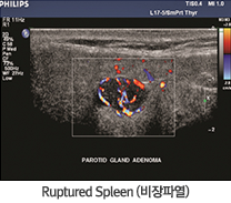 Ruptured Spleen(Ŀ)