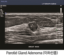 Parotid Gland Adenoma(ϼ)