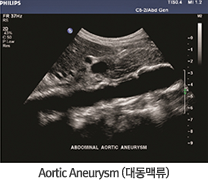 Aortic Aneurysm(뵿Ʒ)