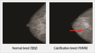 Normal brest() Calcification brest(ȸȭ) Կ